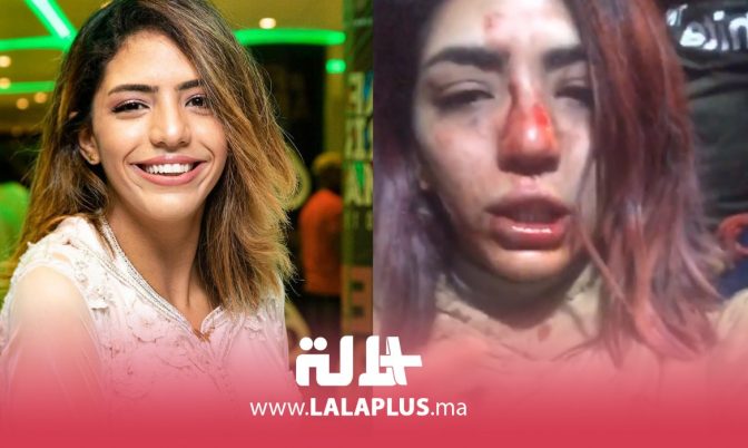 الصخيرات.. مغنية الراب « بسيكو كوين » تتعرض لاعتداء من مجهول (فيديو)