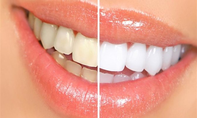 للتخلص من إصفرار الأسنان طبيعيا.. اتبعي هذه الوصفات