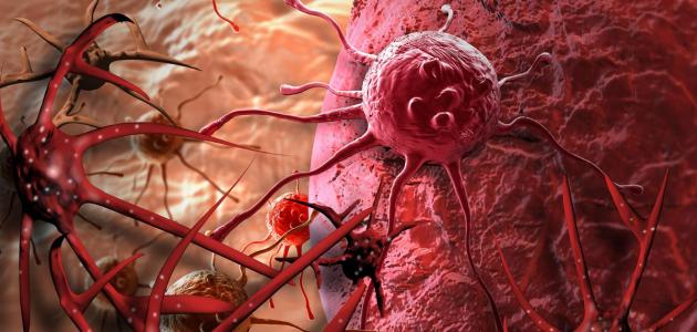دراسة تحذر: التوتر المزمن ينشط عمل الخلايا السرطانية