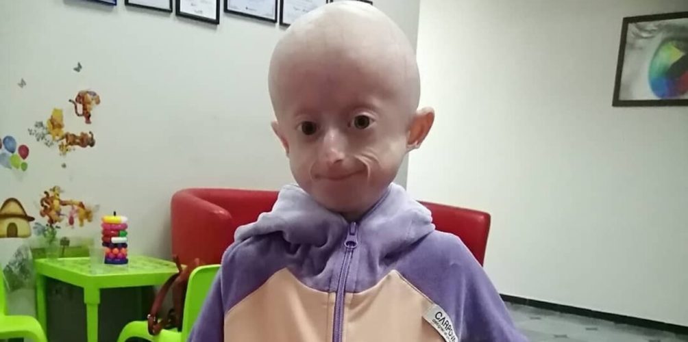 حالة نادرة جدا.. طفلة في الـ10 من عمرها تفارق الحياة بسبب الشيخوخة المبكرة