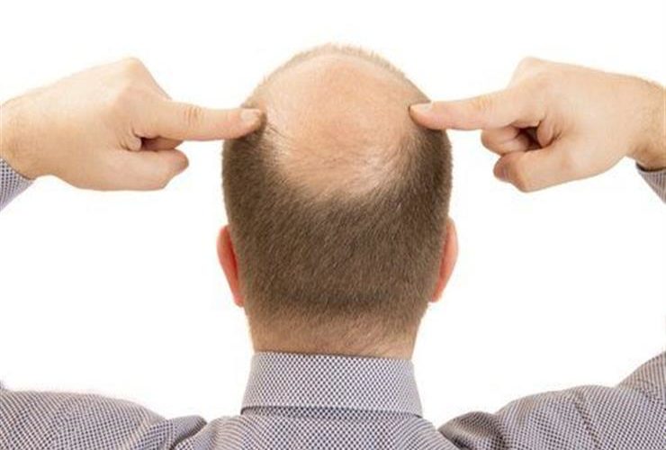 خبر سار لأصحاب الصلع الوراثي.. صينيون يخترعون لصاق للعلاج