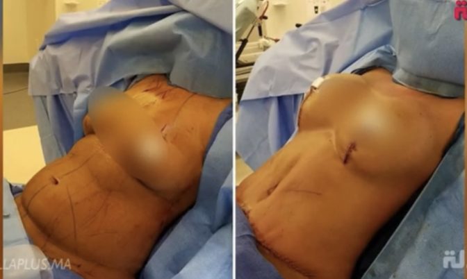 أخصائية في التجميل: أغلبية النساء فالمغرب كيديرو شفط الدهون ونحت الجسد وتكبير المؤخرة