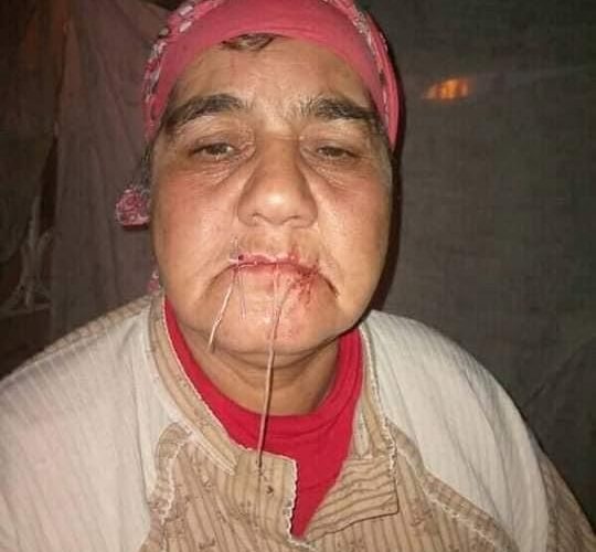 احتجاجا على عدم منحها كشكا.. سيدة تخيط فمها(صور)