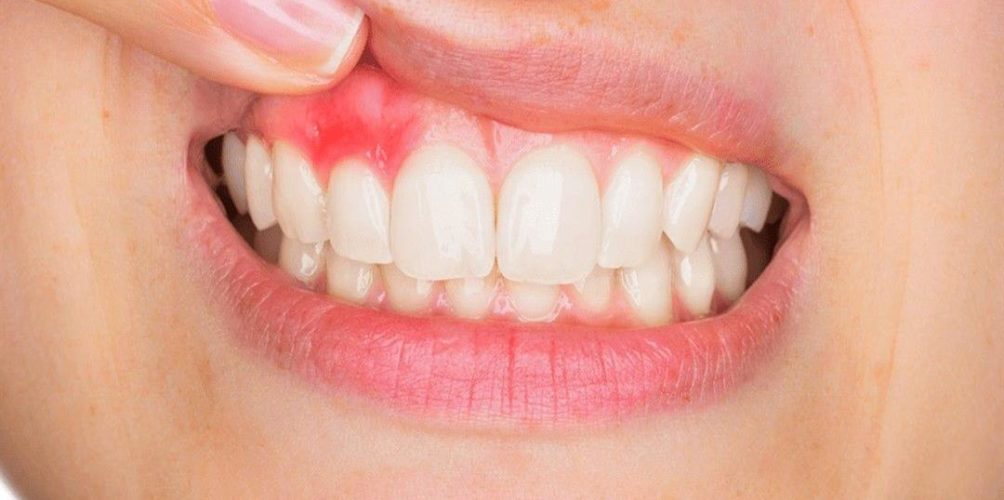 من بينها أمراض القلب والأوعية الدموية.. مشاكل صحية وراء إلتهاب اللثة
