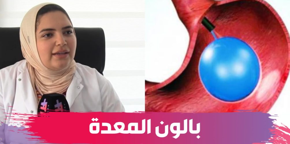 بدون جراحة وبدون تخدير.. بالون المعدة تقنية جديدة لإنقاص الوزن (فيديو)