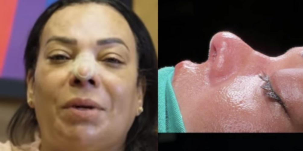 لأسباب صحية.. بشرى أهريش تخضع لعملية تجميل في تركيا ونشطاء يتهمونها بالكذب