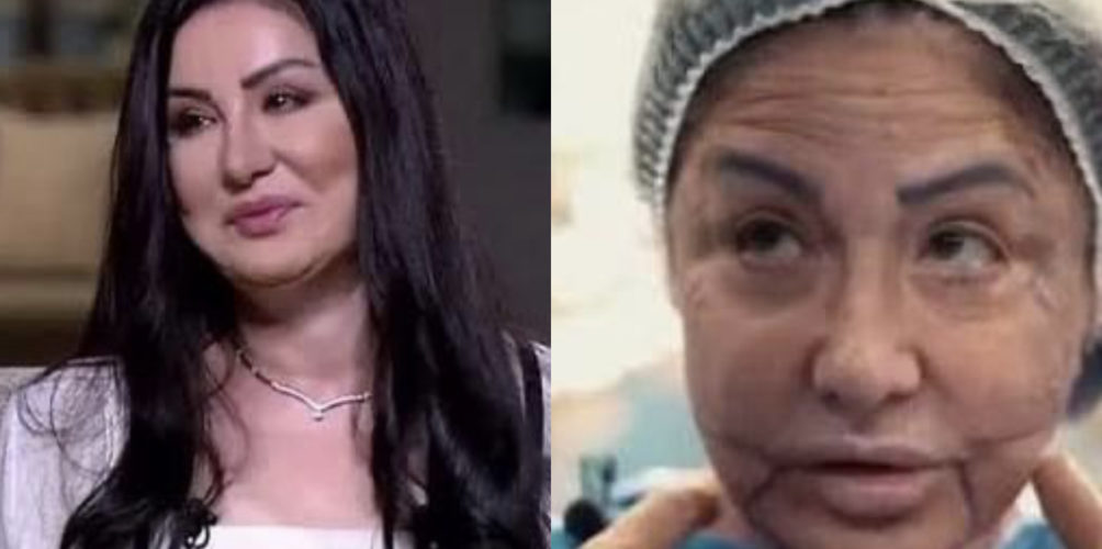 جراء عملية تجميل فاشلة.. فنانة سورية تتعرض للتشوه