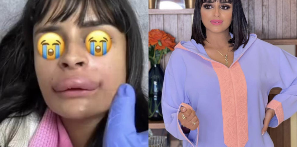 تشوه على الوجه.. المؤثرة « شيك شوب » ضحية عملية تجميل فاشلة